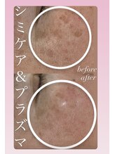 アールエム ボーテ(RM beaute')/シミケア.毛穴.プラズマ