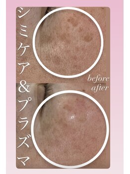 アールエム ボーテ(RM beaute')/シミケア.毛穴.プラズマ