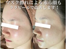 ホワイトアクア 加古川店(WHITE AQUA)/ララピール/兵庫/加古川/毛穴