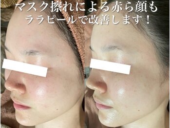 ホワイトアクア 加古川店(WHITE AQUA)/ララピール/兵庫/加古川/毛穴