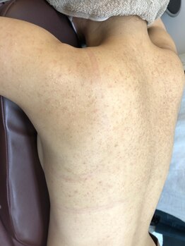 ココティー(Cocotii)の写真/[ハーブピーリング両二の腕]両腕側面¥33000→¥26400/肩含む(or前腕)¥44000→¥35200/肩周り¥22000→¥17600