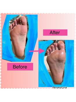 リゼラアンドコー 宇都宮店/角質ケア/角質除去、フットケア