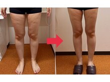 まいれ整骨院 大津市堅田院 マイレ 堅田店(MAILE)/☆痩身ビフォーアフター☆