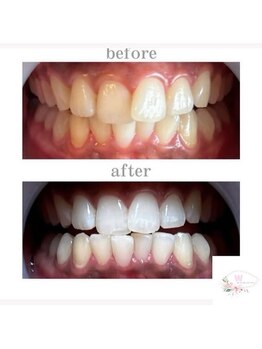 ホワイトニングショップ 本厚木店/【ビフォーアフター】10回