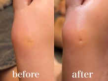 ドクターネイル爪革命 札幌本店/症例紹介１４　たこ・うおのめ