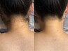 【うなじ革命｜うなじ脱毛】アップスタイルがもっと素敵に。＜福岡｜脱毛＞