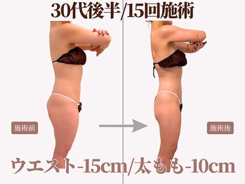 ベモーレ 谷町九丁目 上本町/30代後半/15回施術