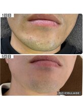 アイアイくらぶ美容部/ひげ脱毛