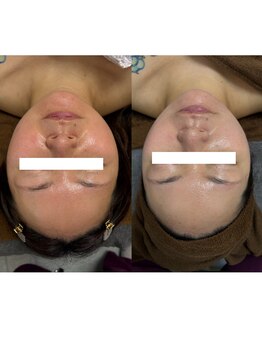 リノンクリニカル(LIINON clinical)/高周波×脂肪燃焼フェイシャル