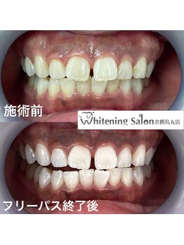 ホワイトニングサロン 京都烏丸店/ホワイトニング施術例
