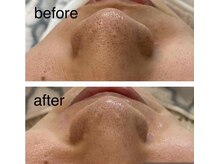 スター(STAR)/バイウォミーパック１回