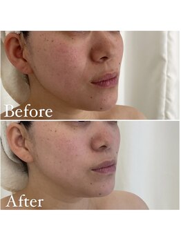 ミエル 神戸店(Miel)/リアボーテハーブトリートメント