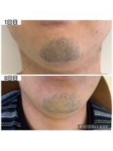 アイアイくらぶ美容部/ひげ脱毛