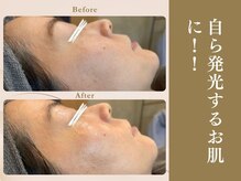 ベラノーブル(bella noble)/プロの産毛剃りで発光するお肌へ