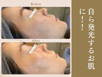 ベラノーブル(bella noble)/プロの産毛剃りで発光するお肌へ