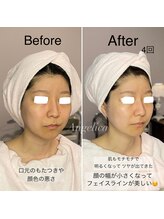 アンジェリカ(Angelica)/フェイスラインや口元のもたつき