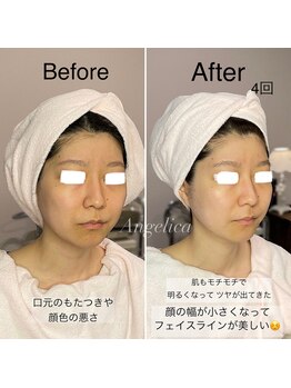 アンジェリカ(Angelica)/フェイスラインや口元のもたつき