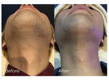 ルーナ(Luna)/メンズ 髭脱毛