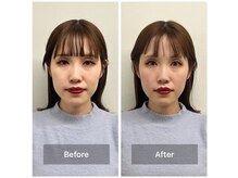 ヴィーライン 恵比寿本院(VeLine)/お客様Before After/小顔効果