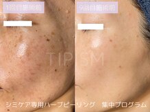 ハービー(Herbee)/肌質の根本改善