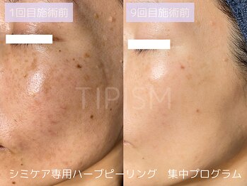 ハービー(Herbee)/肌質の根本改善