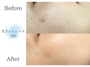 ディアスマイル(Dear.smile)/光フェイシャル3回