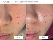 ヒーリングハーツ(Healing Hearts)