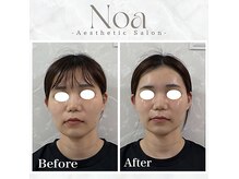 ノア 新宿(Noa)の雰囲気（ハーブピーリング/ニキビケア/小顔矯正/美肌/毛穴/たるみ/新宿）