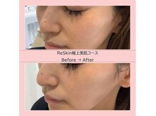 ディアメ(Diame)/つるつる美肌は手に入れれる！
