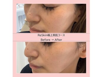 ディアメ(Diame)/つるつる美肌は手に入れれる！