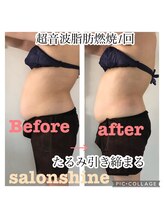 サロンシャイン(Salon Shine)/痩身マッサージ１回