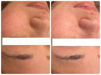 メゾンリュバン 天王寺(Maison Ruban)/毛穴洗浄・美白フォト|毛穴ケア