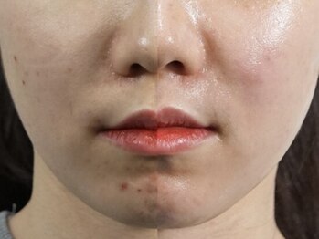 GRACETHOUSAND(グレイスサウザンド)/【韓国肌管理】ララピール