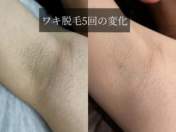 ソレイユ ベル(Soleil Belle)の写真/【最短で脱毛終了するならココ！】毎回同じ担当者が担当するので脱毛デビューの方にもオススメです♪