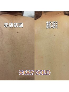 ステイゴールド 新百合ヶ丘(STAY GOLD)/自分で見えない背中脱毛!人気!