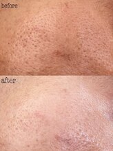 ラヴァン(LaVan)/復元パック施術直後の効果