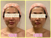 美肌痩身サロン ラエルヴェ(La Elever)/小顔リフトアップ大作戦！ 