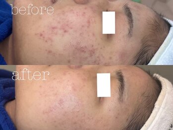 ロイ 初生店(LOI)/ハーブ×プラズマ