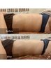 1回で劇的変化！【美容溶解×痩身機器】凸凹セル撃退120分¥40700→¥30700