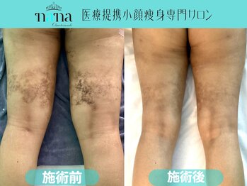 ナナ 銀座(Nana)/脂肪後の黒ずみのお悩みの方へ