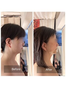 ラ ブリエ(La Briller)/マリオネットライン改善も!