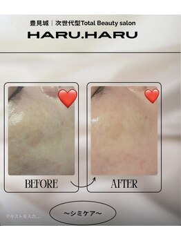 ハルハル(Haru Haru)/~シミケア~バクテリウム編。