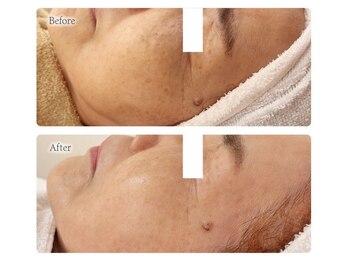 オービーエム 博多阪急店(O.B.M)/【70代シミケア症例】