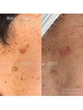 キレイシェア バイ プリンセスローズ静岡駅店(KIREI SHARE)/光フェイシャル