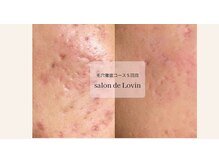 サロンドラヴィン(salon de Lovin)の雰囲気（何をしてもダメだった肌が変わる肌調子が良いと前向きになれる）