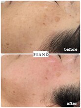 ピアーノ(PIANO)/エルモサハーブピーリング