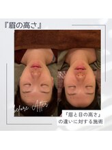 モアフェイス 池袋店(More Face)/小顔矯正　例7