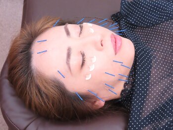 ヒューマン鍼灸接骨院/美容鍼でスッキリ