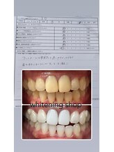 ホワイトニングショップ 久留米店(WHITENING SHOP)/ビフォーアフター