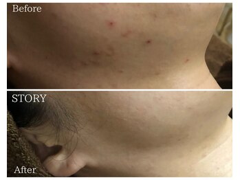 ストーリー 沼津店(STORY)/ハーブピーリング専門店STORY